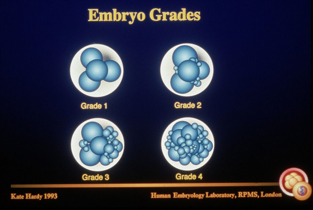 임신 반복 실패 — 배아 등급 평가와 착상 성공률