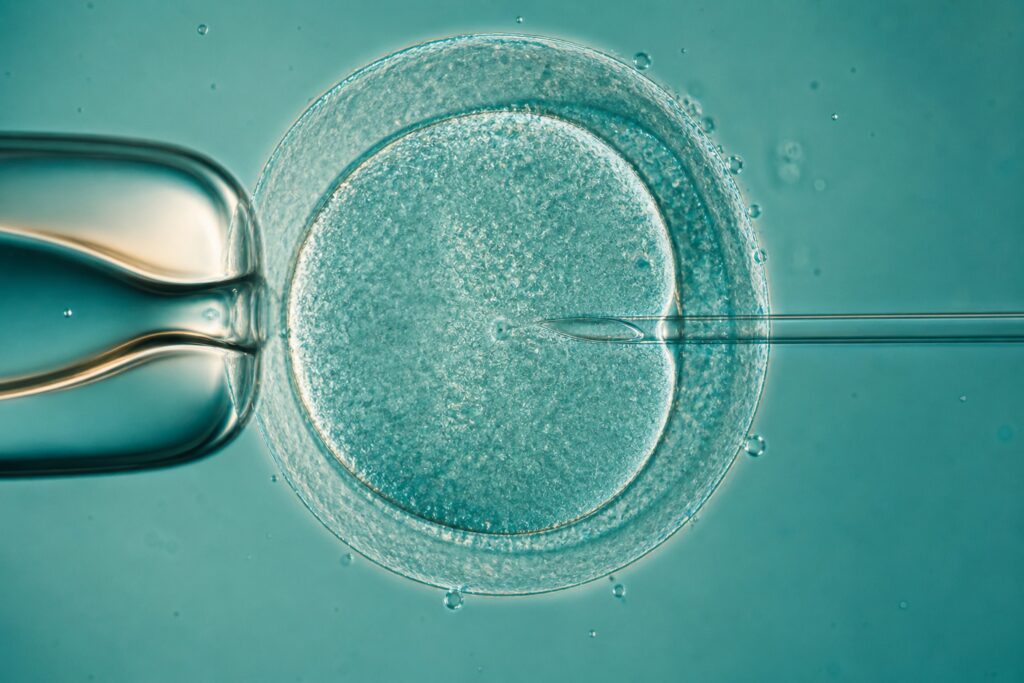 ICSI 시술 — 글로벌코리아IVF
